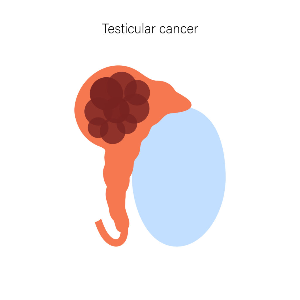 Testicular cancer